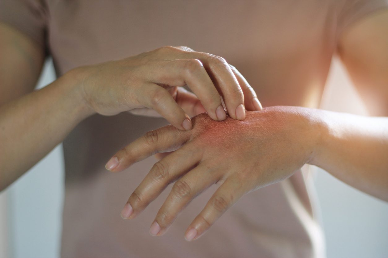 iStock/ حساسية الجلد