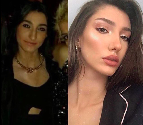 ملكة جمال تركيا قبل وبعد عملية التجميل