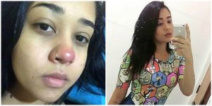 شابة صغيرة تصاب بالشلل التام بسبب ثقب في الأنف!