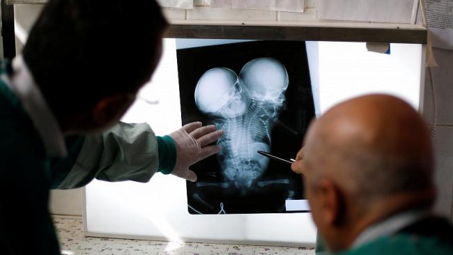 وفاة توأمين ملتصقين باليمن كانا بحاجة للعلاج بالخارج ومنعهما إغلاق المطار