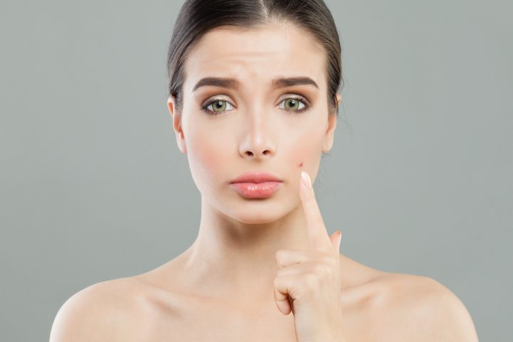 iStock\  هناك طرق طبية وأخرى طبيعية لعلاج حب الشباب 
