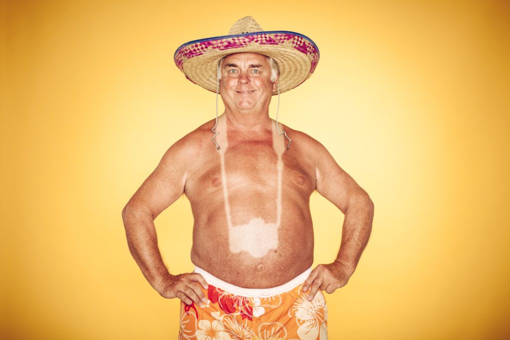 علاجات منزلية لحروق الشمس