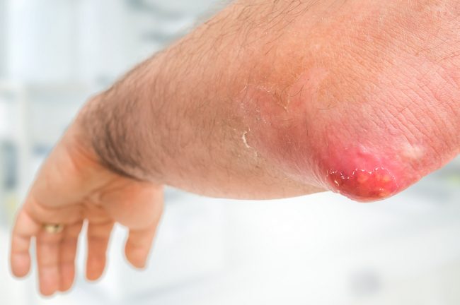 8 أسباب طبية لظهور نتوءات الكوعين وانتشار الطفح الجلدي