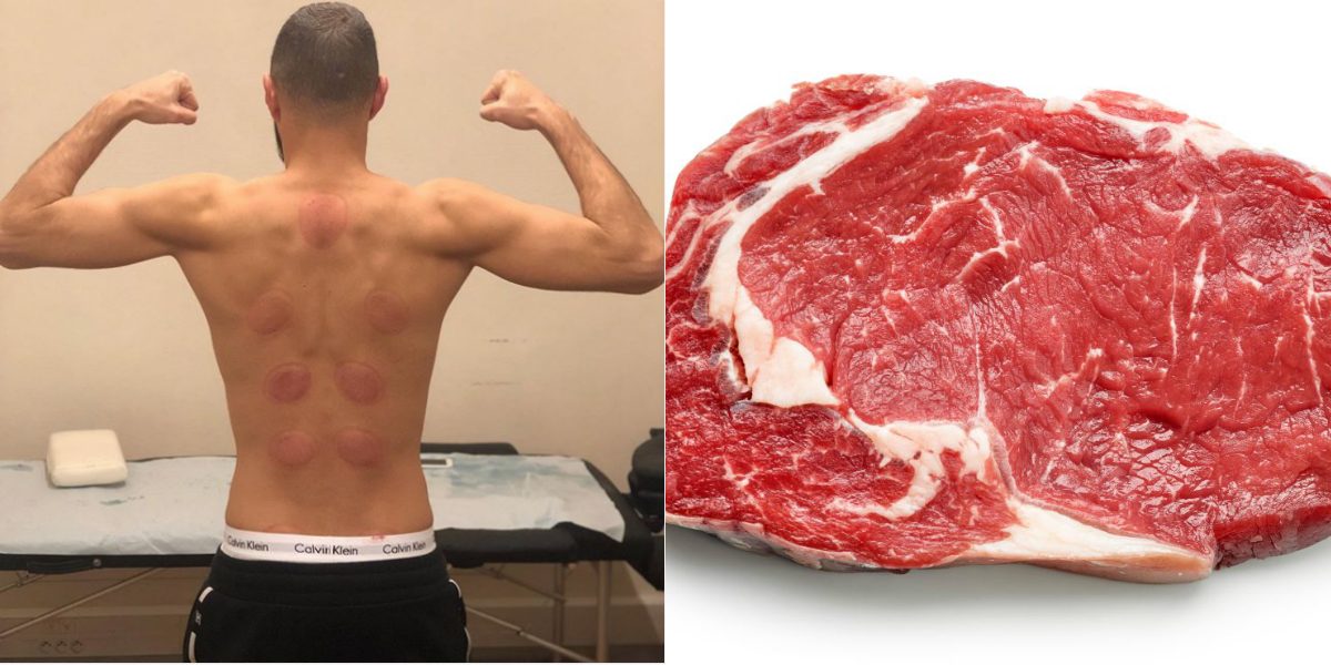 الحجامة وشرائح اللحم.. إليك أغرب طرق علاج إصابات الملاعب