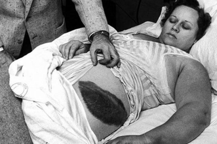  الأمريكية آن هودجز أول بشري يُصاب بالنيزك 