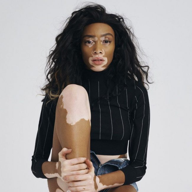 دفع أحدهم لتغيير لون جلده بينما كان سبباً في شهرة آخرين.. كيف تعامَل المشاهير مع مرض البهاق؟