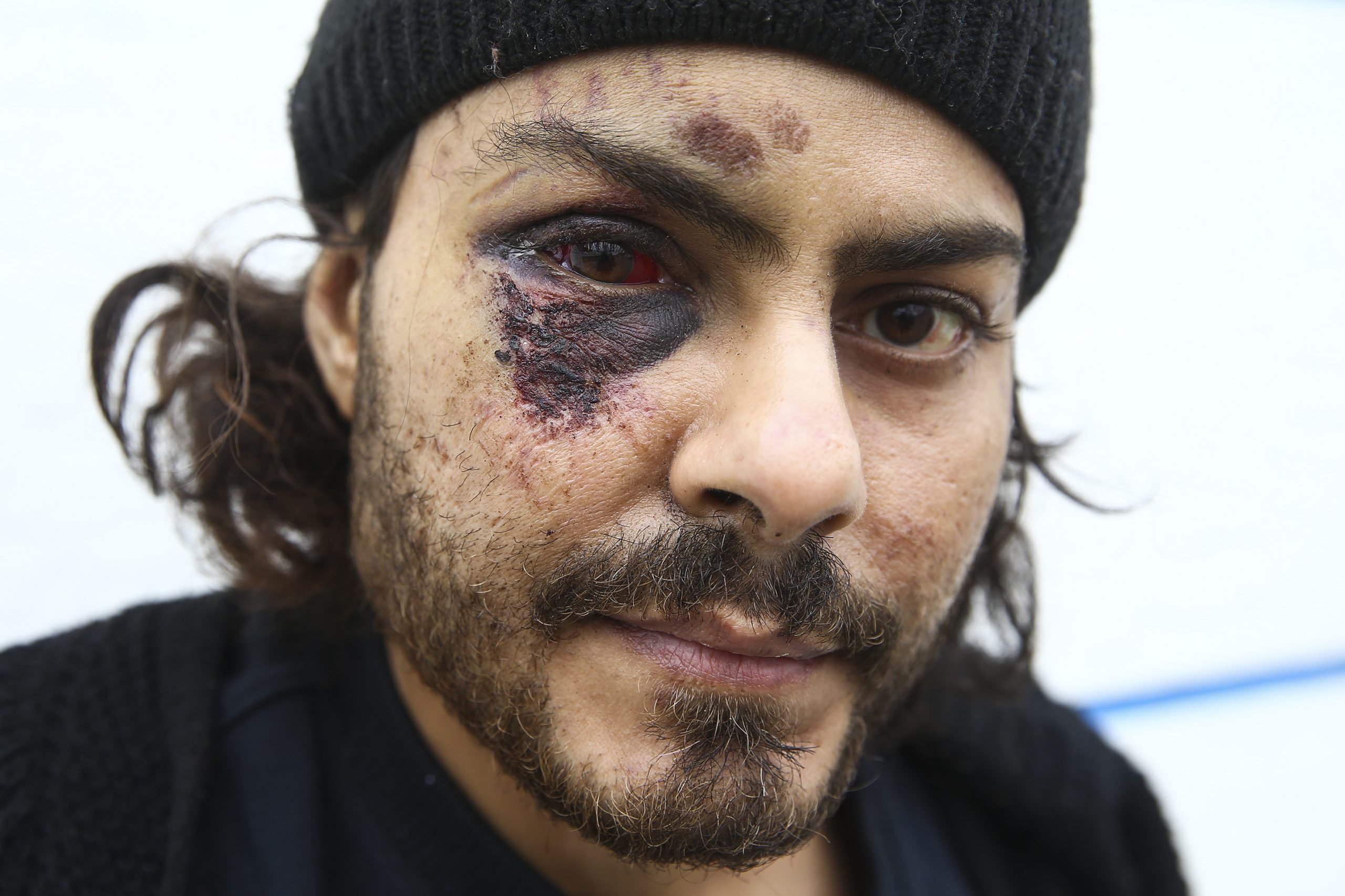 صور صادمة لآثار اعتداء جنود يونانيين بالضرب المبرح على مهاجر مصري.. سلبوه كل ما يملك