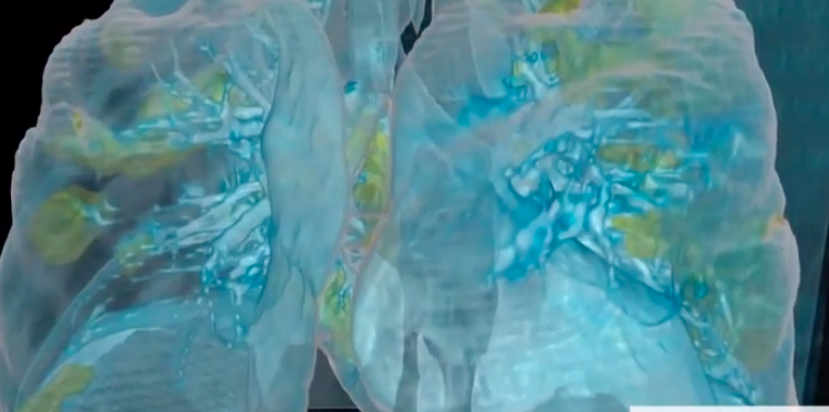 هكذا تبدو رئتا المريض بكورونا.. طبيب ينشر فيديو توضيحياً للآثار المدمرة التي يسببها الفيروس لمصابيه