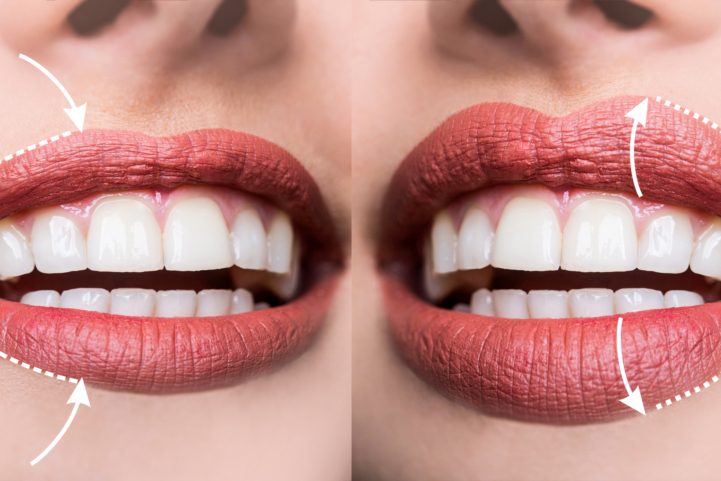istock \فيلر الشفاه