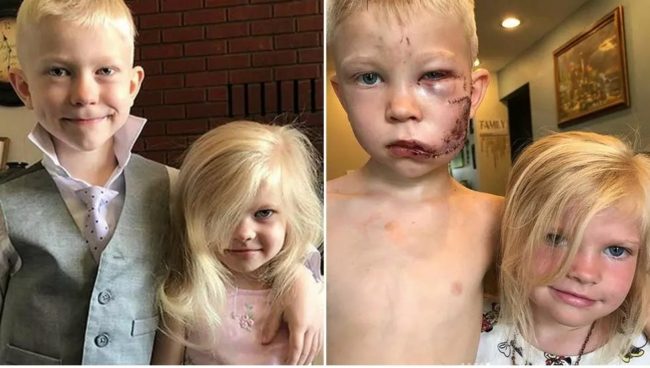90 غرزة في الوجه لينقذ أخته من الموت.. كيف كشف الطفل بريدجر كذب العالم؟