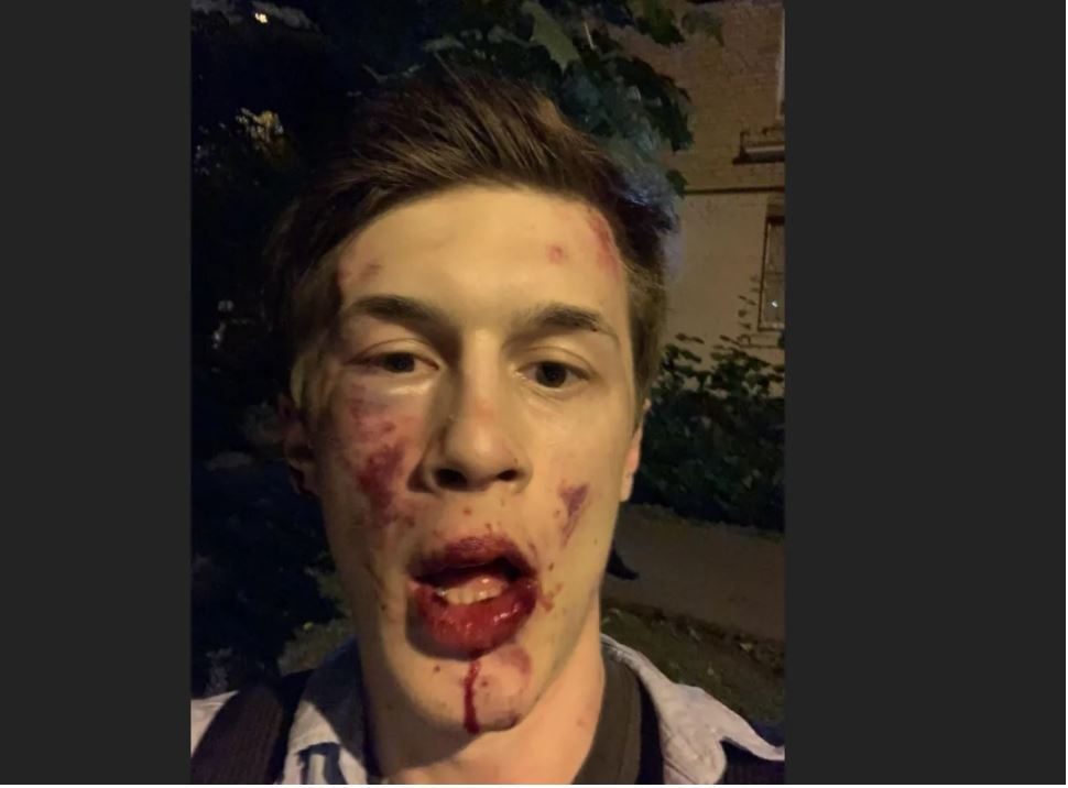 تُرك بوجهٍ متورم تلطخه الدماء.. أحد منتقدي بوتين يتعرَّض للضرب المبرح خارج منزله بموسكو على يد مجهولَين!