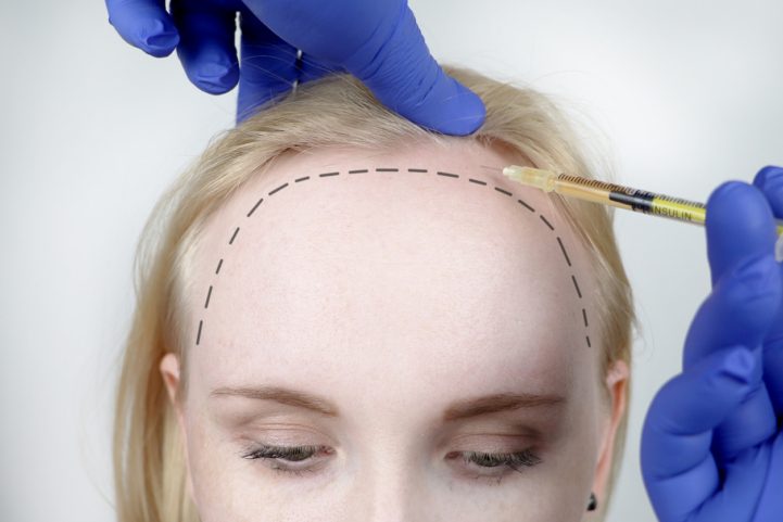 iStock/ زراعة الشعر للنساء