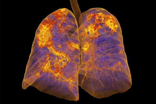 “كوفيد طويل الأمد”.. لماذا لا يتعافى بعض الناس من كورونا وتستمر أعراضه معهم لأشهر عديدة؟