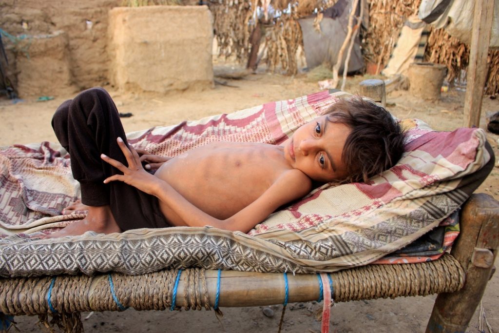 سوء التغذية جائحة كورونا