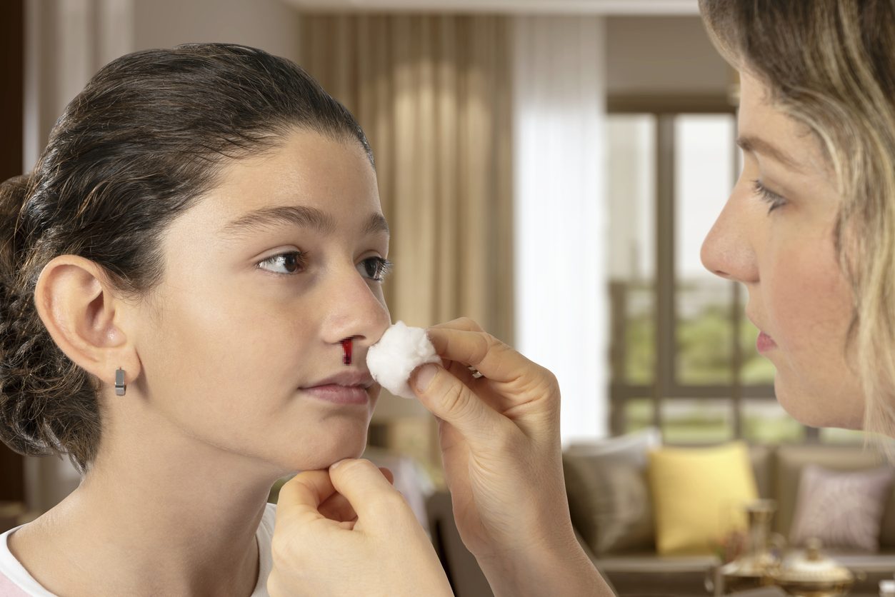 نزيف الأنف عند الأطفال