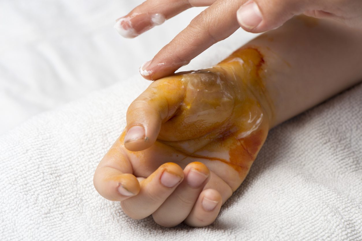 علاجات منزلية فعالة للحروق الطفيفة، وأخرى شائعة الاستخدام لكنها تزيد الوضع سوءاً