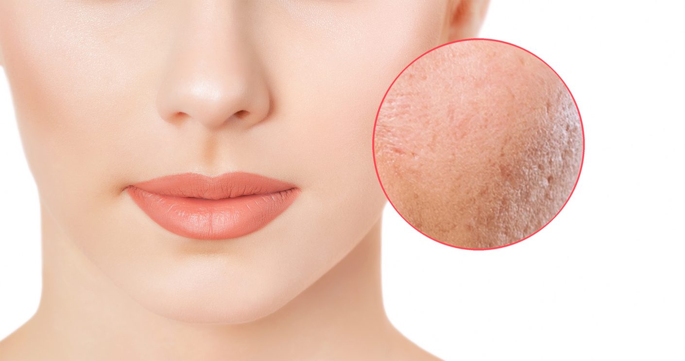 انسدادها ولونها الأسود لا يعني اتساخ بشرتك.. 10 معتقدات خاطئة عن المسام لا تصديقها