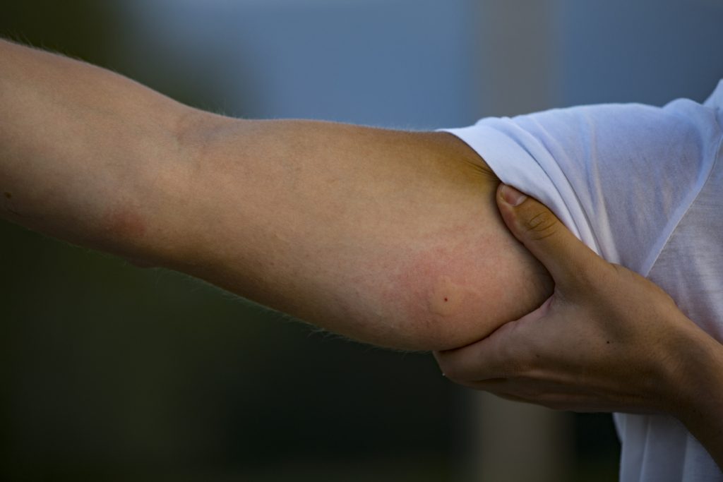 iStock/ لدغات البعوض ومخاطرها