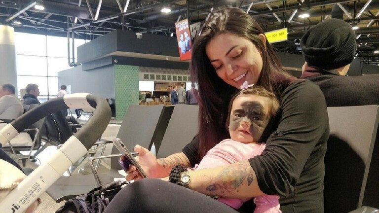 الطفلة الأمريكية وُلدت بعلامة سوداء غطت أنفها وجفونها/ رويترز