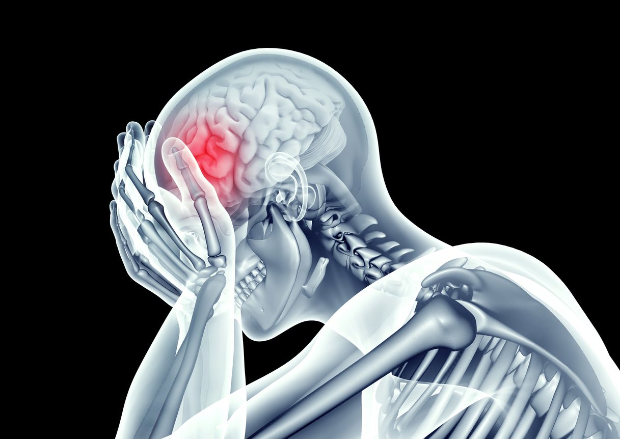 iStock السكتة الدماغية