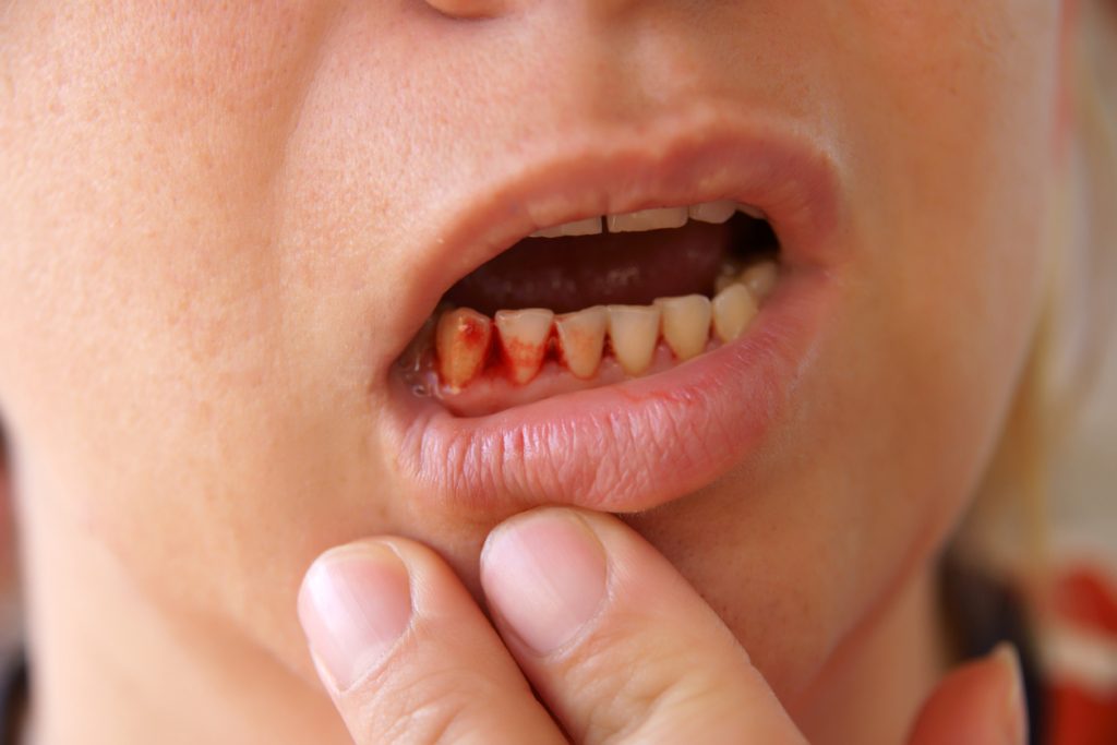 التهاب اللثة/ Istock