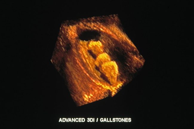 إزالة أكثر من 200 حصوة من كلية رجل هندي.. الجراحة استغرقت ساعة واحدة فقط، بهذه الطريقة