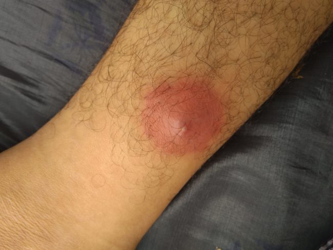 مؤلمة وقد تتحول إلى خرّاج أو تسبب التهابات شديدة.. أسباب ظهور الدمامل وطرق علاجها