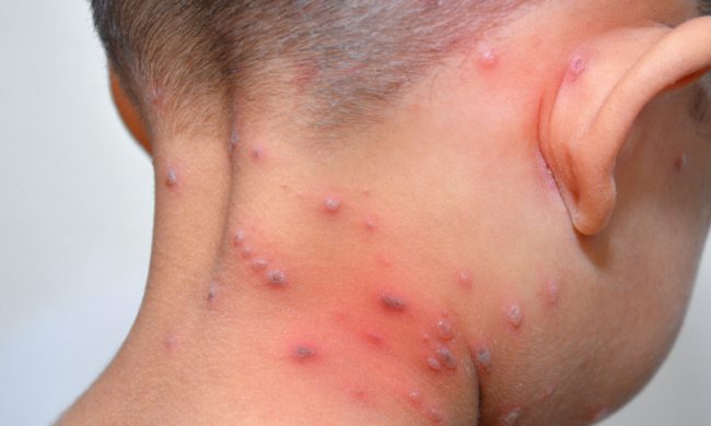 جدري القرود يصل إلى الشرق الأوسط.. إسرائيل تسجل أولى حالات الإصابة وقد تشتري مئات اللقاحات