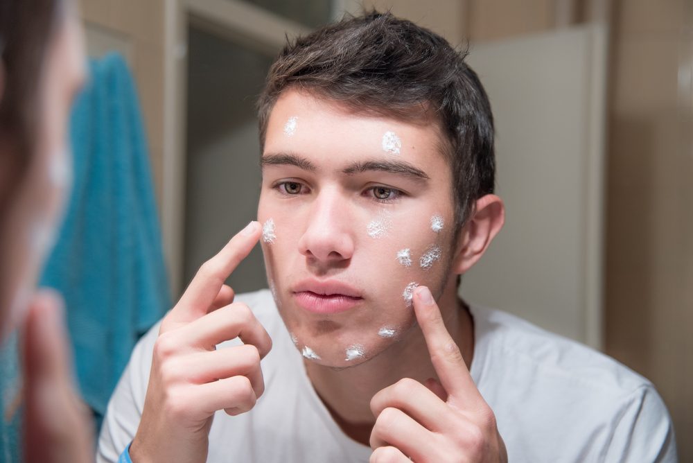 قد يبدأ حب الشباب في الظهور بعد البلوغ والنضج - ShutterStock