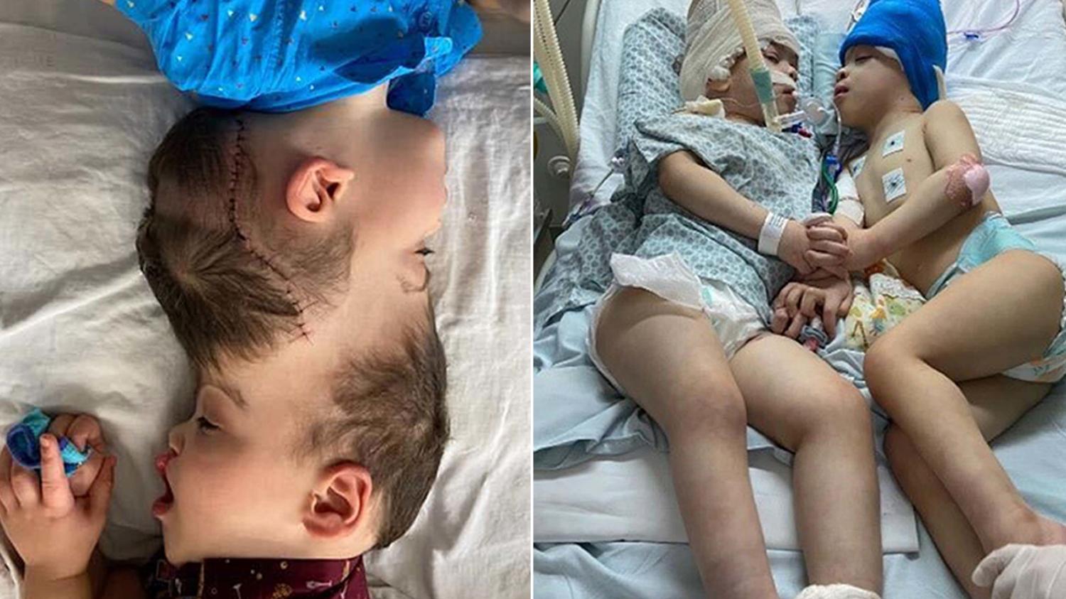 أطباء ينجحون في فصل توأم ملتصق بتقنيات الواقع الافتراضي.. الجراحة استغرقت 27 ساعة وشارك فيها 100 طبيب