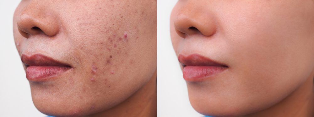 يجب مراجعة الطبيب المتخصص قبل اتخاذ قرارات تجميلية لعلاج آثار الحبوب - ShutterStock