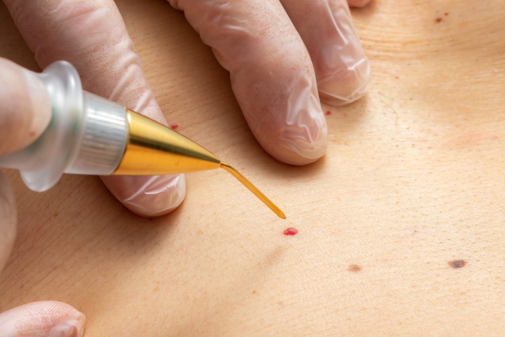 يتم علاج الشامات الحمراء تجميلياً، لكنها لا تستلزم الإزالة - ShutterStock