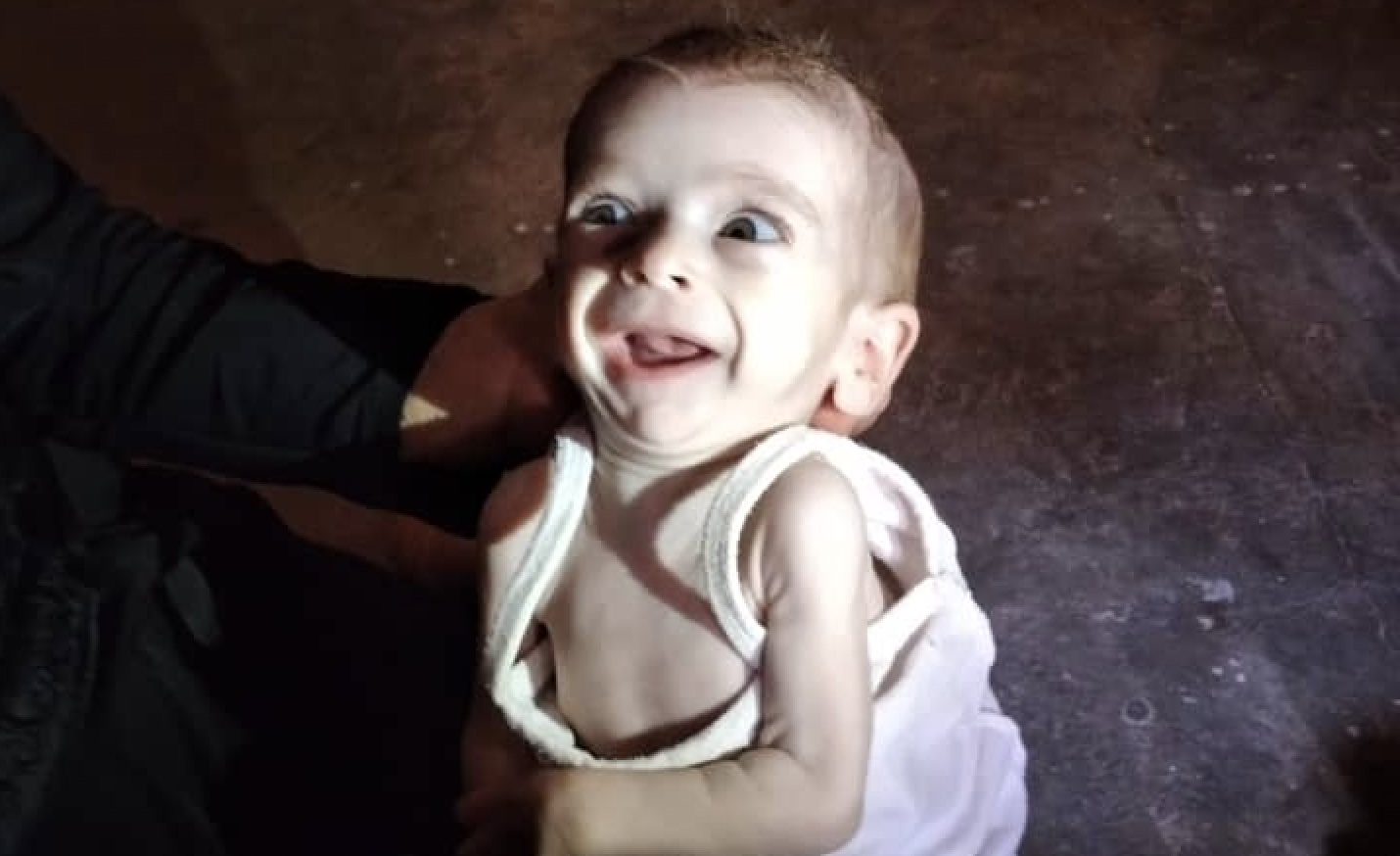 تعاني من فتحة في سقف الحلق! الطفلة السورية “يقين” تلتمس قراراً أردنياً لإنقاذها من الموت (فيديو)