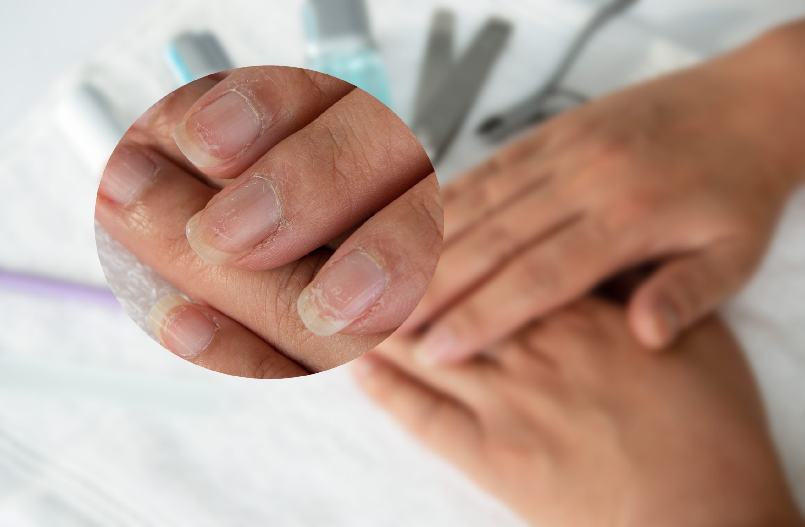 هشاشة الأظافر بعد إزالة الجل| shutterstock
