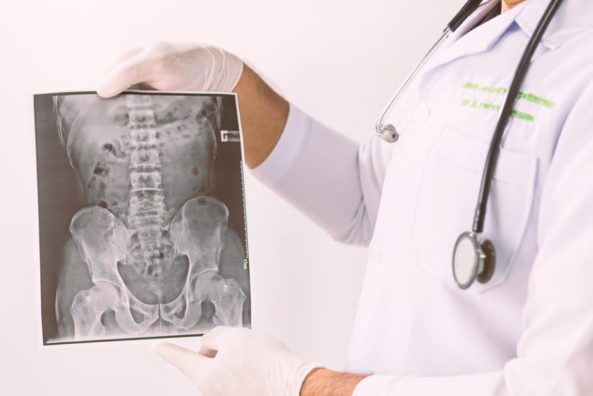 تعاني آلام الظهر المزمنة وخشونة الرقبة؟ هذه أعراض “التهاب الفقار اللاصق” الذي قد يهددك بتقوس الجسم