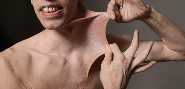 لها ثلاثة أنواع وأخطرها يؤدي لتمزق الأوعية الدموية.. متلازمة “إهلرز دانلوس” التي تسبب مرونة الجلد