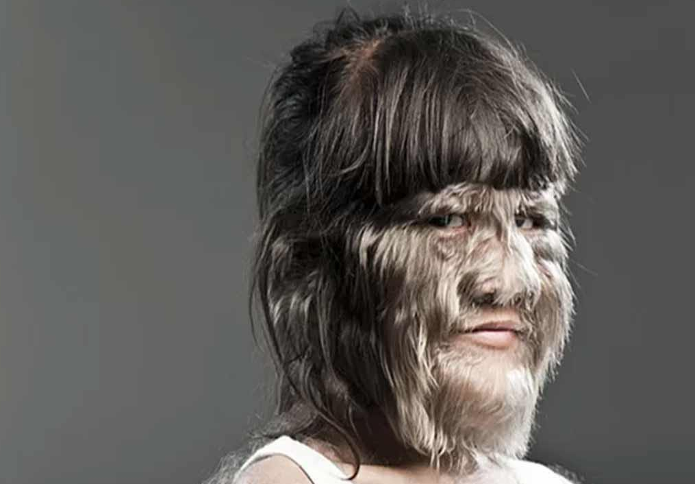 مرض المستذئب