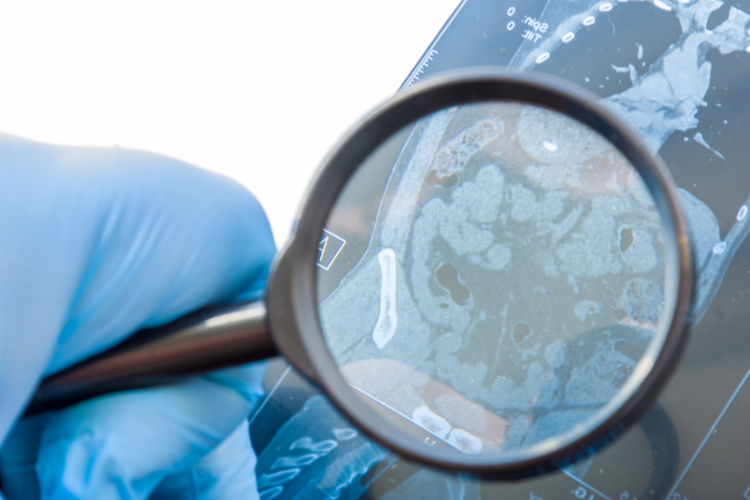 تشخيص شلل الامعاء|shutterstock
