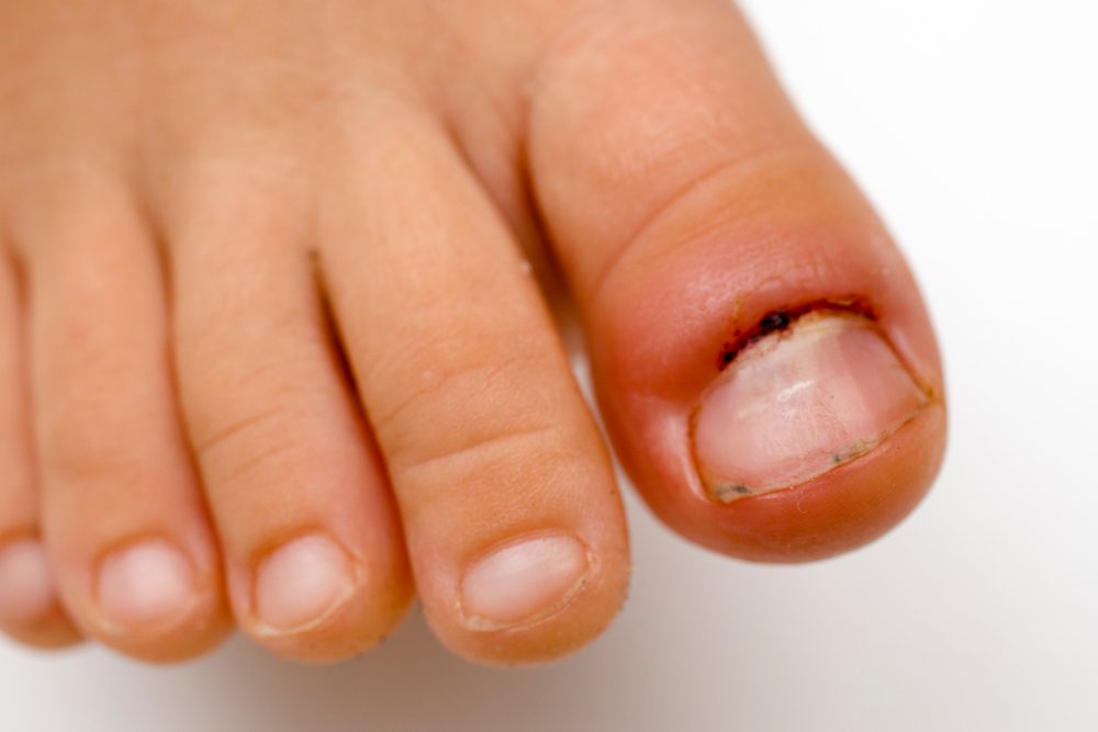 يمكن للالتهاب أن يصيب اليدين والقدمين - ShutterStock