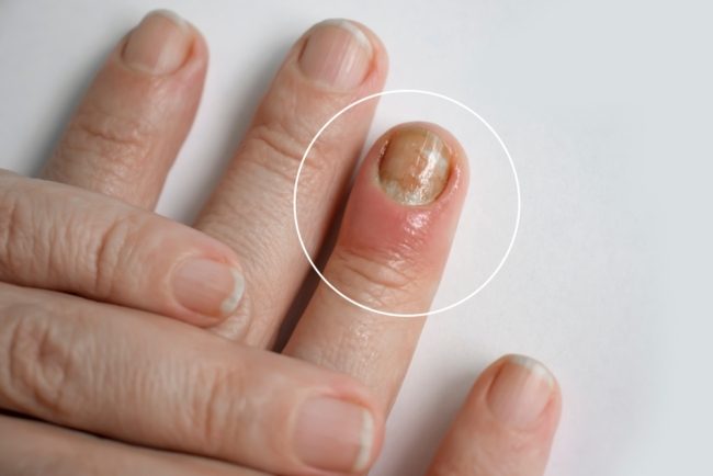 التهاب مؤلم قد يتطور إلى غرغرينا خطيرة! أعراض الإصابة بـ”داحس الظفر” وطرق العلاج والوقاية منه