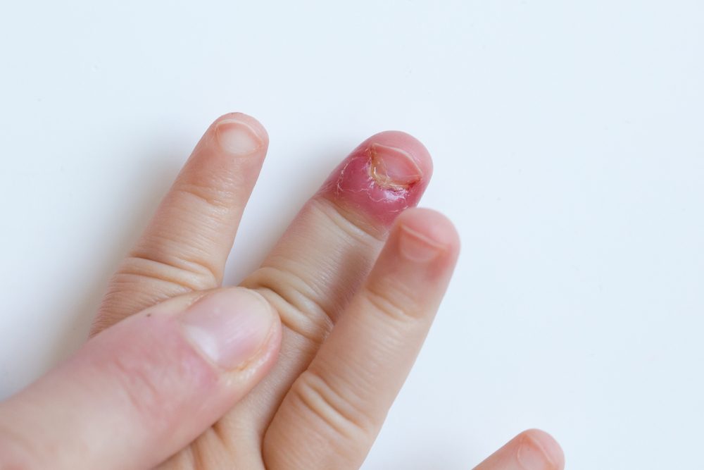يصاب الأطفال بتلك الحالة أيضاً - ShutterStock