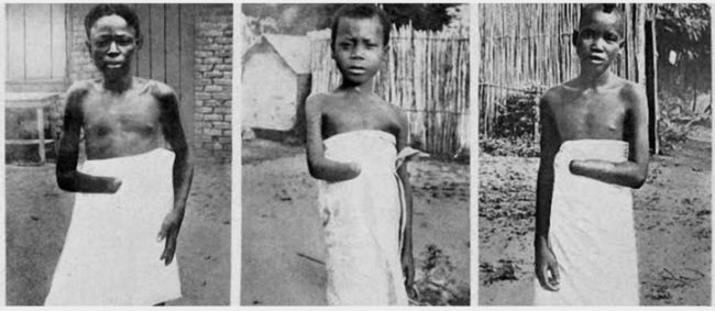 راح ضحيته أكثر من 10 ملايين شخص! استعمار بلجيكا للكونغو الذي حوّلها لمزرعة من العبيد مقطوعي الأيدي