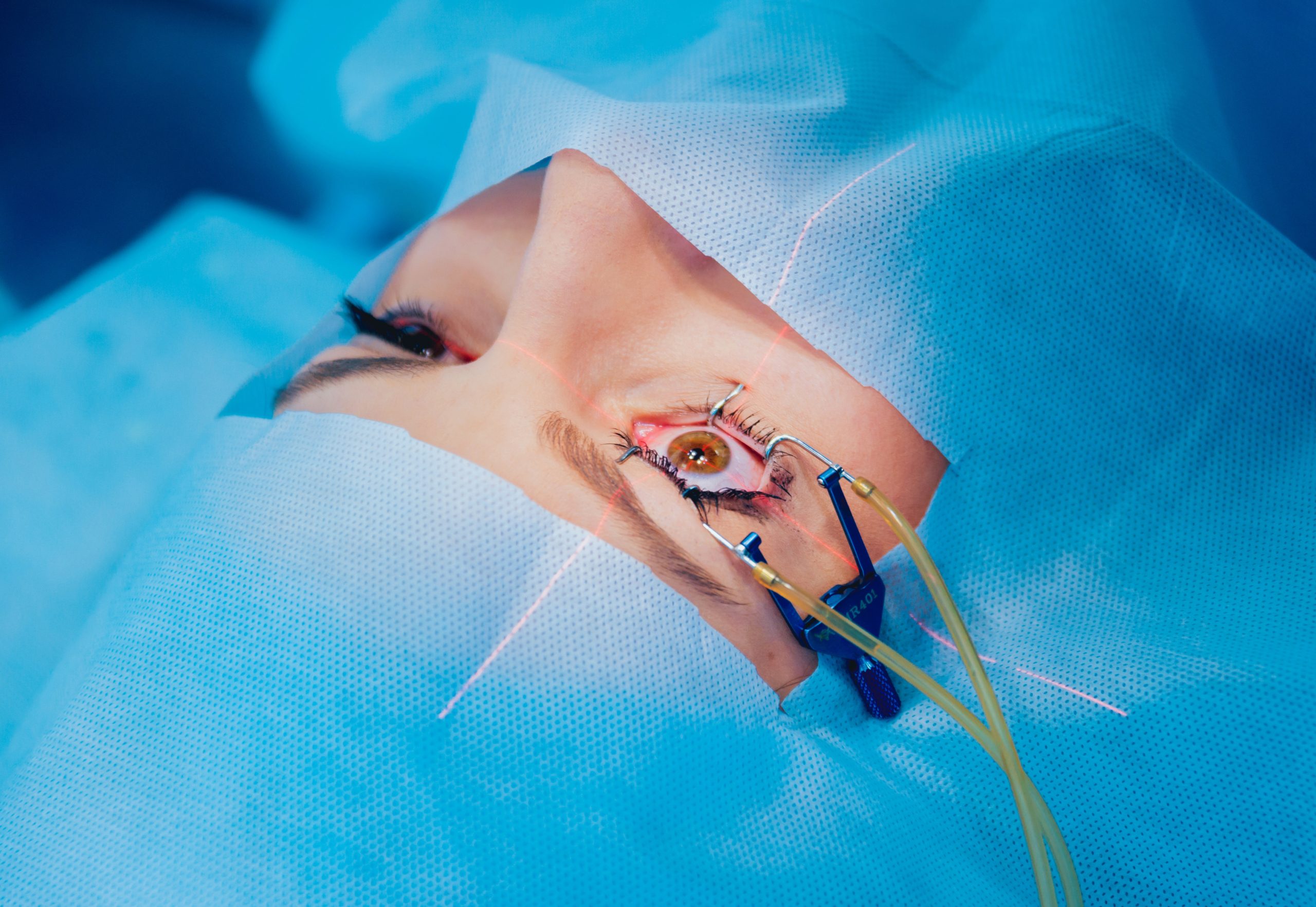 الفيمتو ليزك