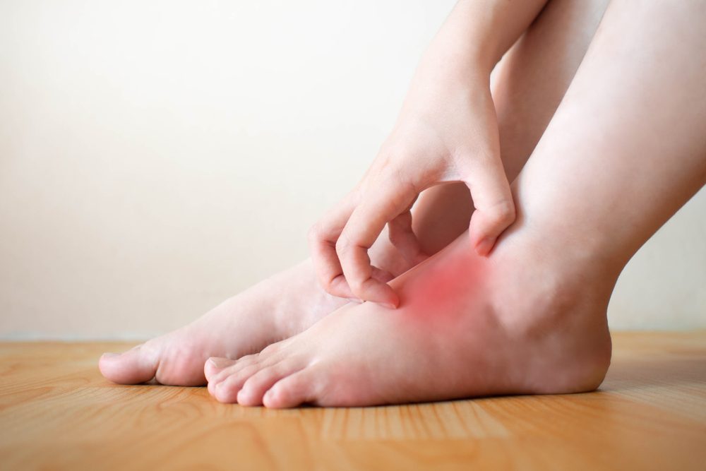 عادة ما تحدث حكة القدم والساق في وقت واحد بسبب نفس العامل - ShutterStock