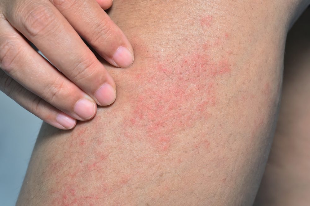 الجهد البدني الجديد قد يؤدي لحكة الجلد بسبب تمدد الأوعية الدموية - Shutterstock