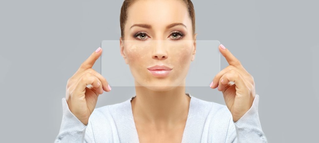 التقشير الكيميائي