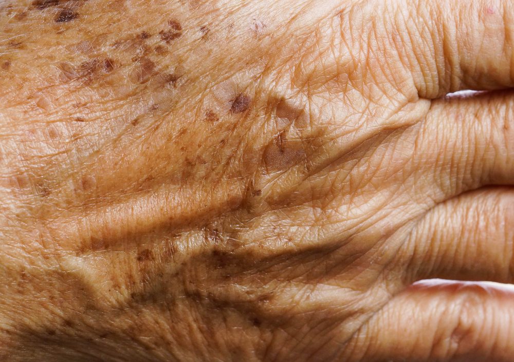 الجينات والتعرض للشمس من الأسباب الأبرز لحدوث النمش - ShutterStock