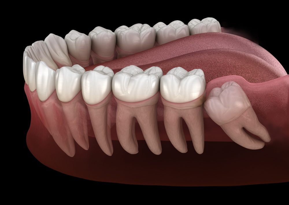  الضرس المطمور يكون مدفونا جزئياً أو كلياً تحت اللثة - ShutterStock