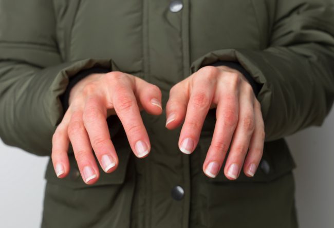 يمكن أن تصل خطورتها إلى بتر المنطقة المصابة.. أسباب عضة الصقيع وطرق الوقاية منها