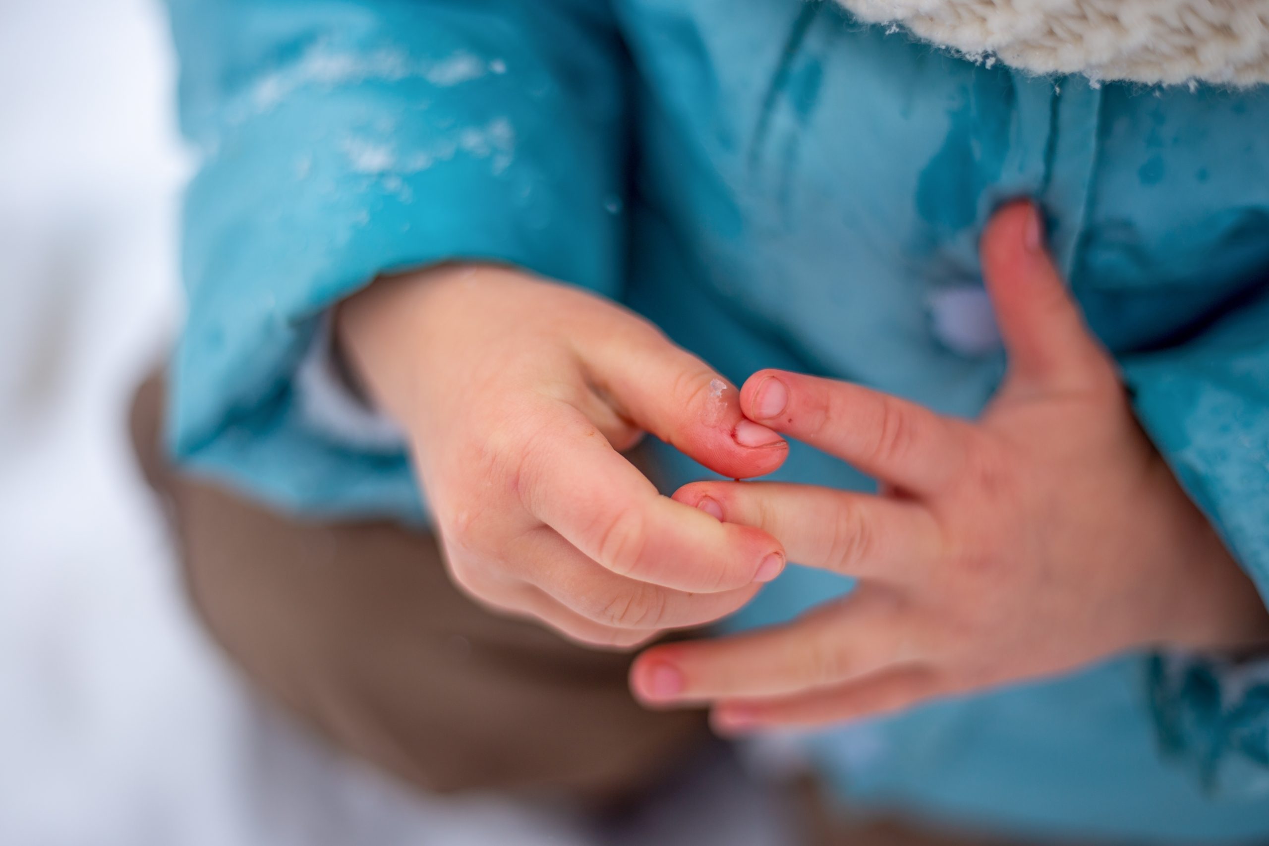 أعراض عضة الصقيع|shutterstock